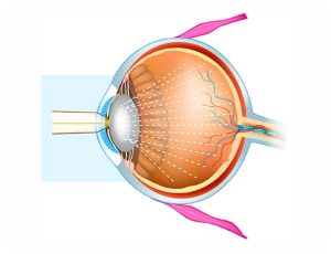 Paediatric cataract