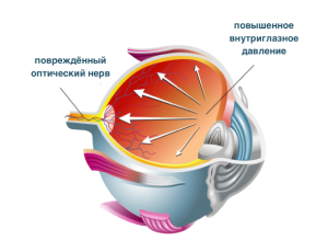 Congenital glaucoma